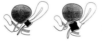 Pesser halka Düğme ile Delikli  Küp Pesser Cube Pessary Perforated with Button